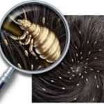 Des poux dans les cheveux
